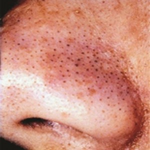 black-head-treatment      
